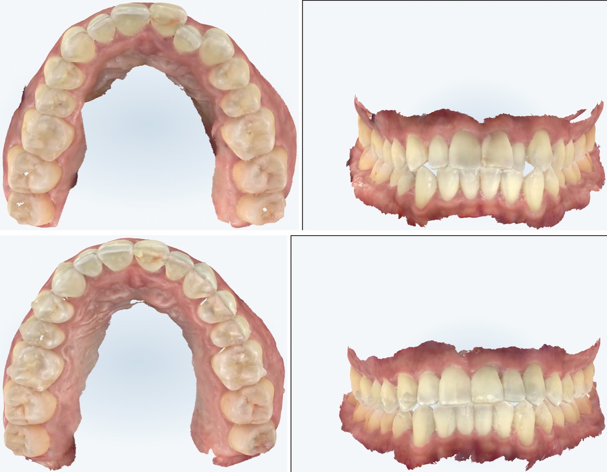 Before and after digital scans of a third real Zusin Dental patient's arches, showing crowding and an anterior crossbite resolved with Invisalign