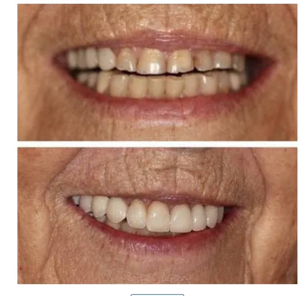 Before and after photos of a full smile makeover at Zusin Dental