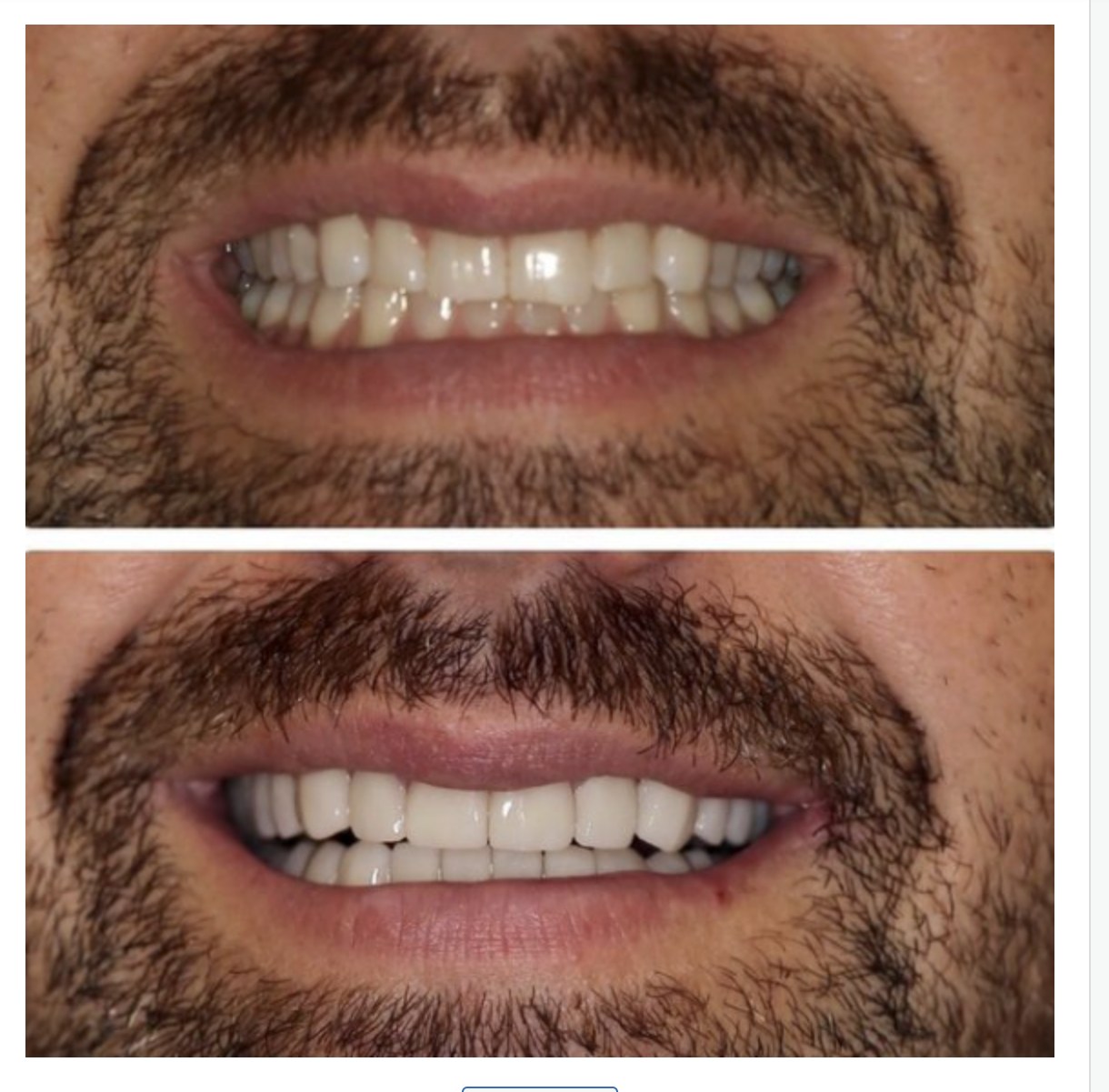 Before and after photos of a full smile makeover at Zusin Dental