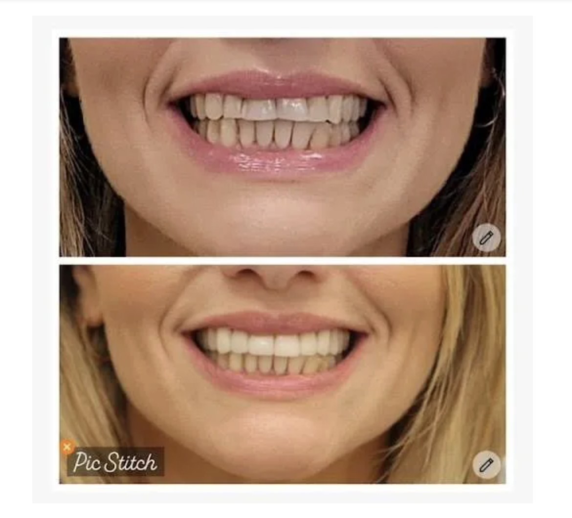 Before and after photos of a full smile makeover at Zusin Dental