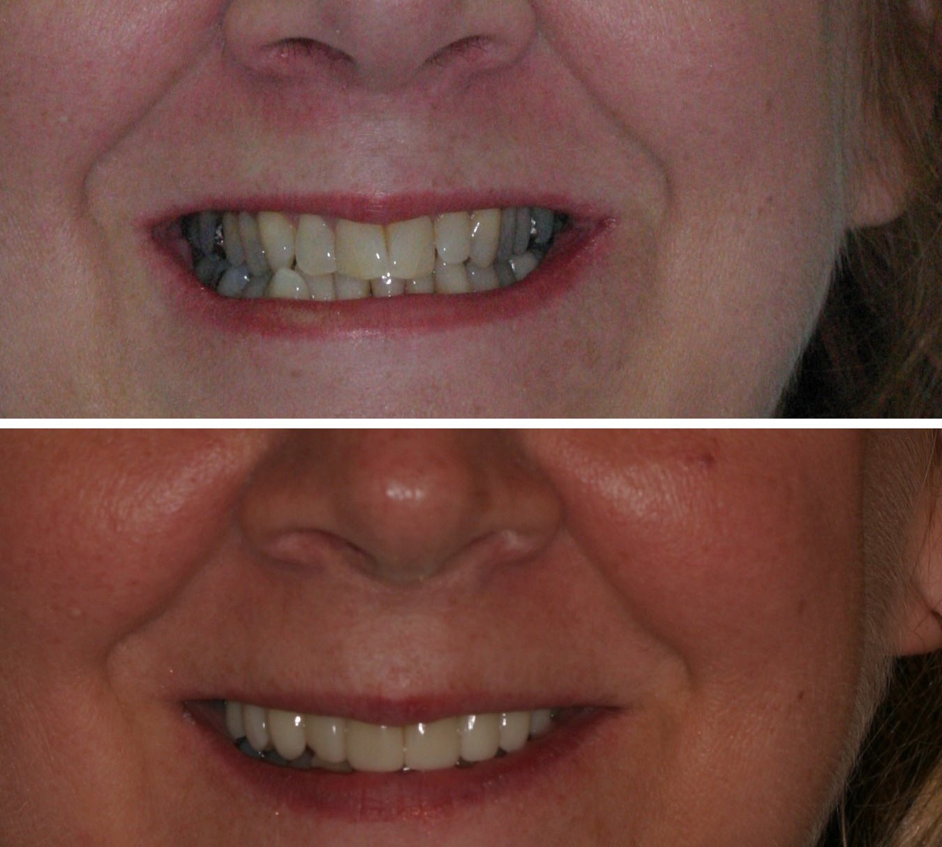 Before and after photos of a porcelain veneers restoration at Zusin Dental