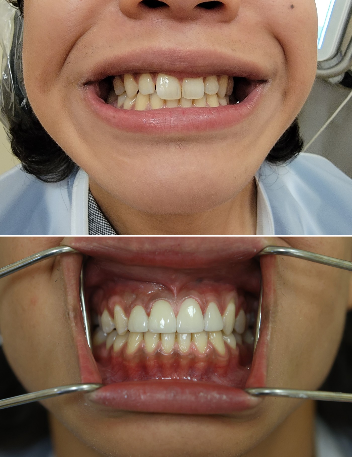 Before and after photos of four anterior porcelain veneers at Zusin Dental