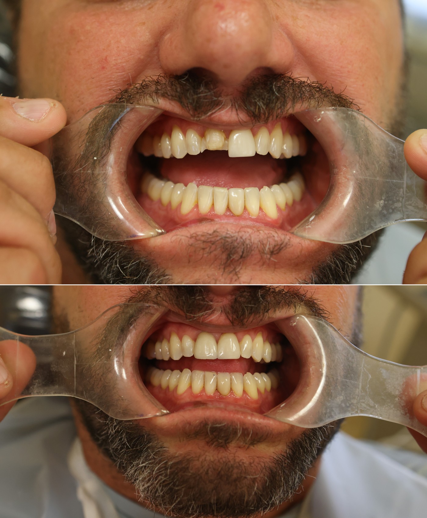 Before and after photos of a front tooth veneer at Zusin Dental