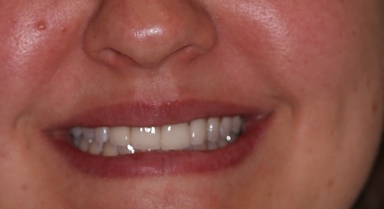 Close-up smile photo of four anterior porcelain veneers at Zusin Dental
