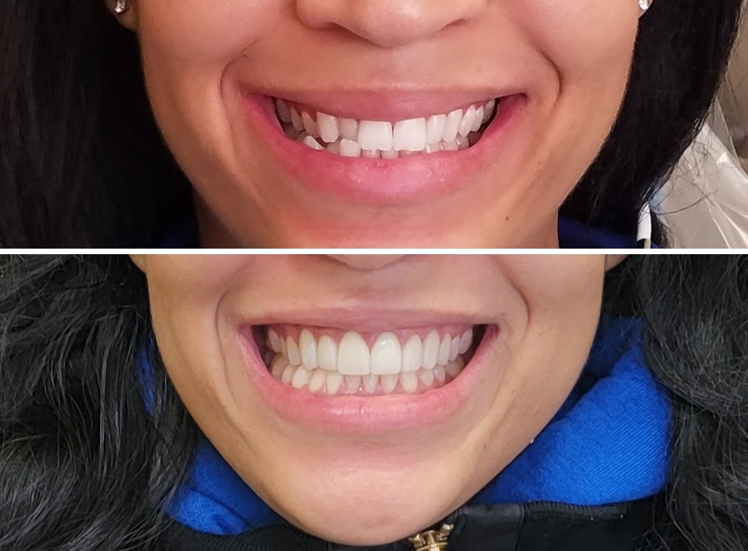 Close-up smile photo of a patient's porcelain veneers at Zusin Dental
