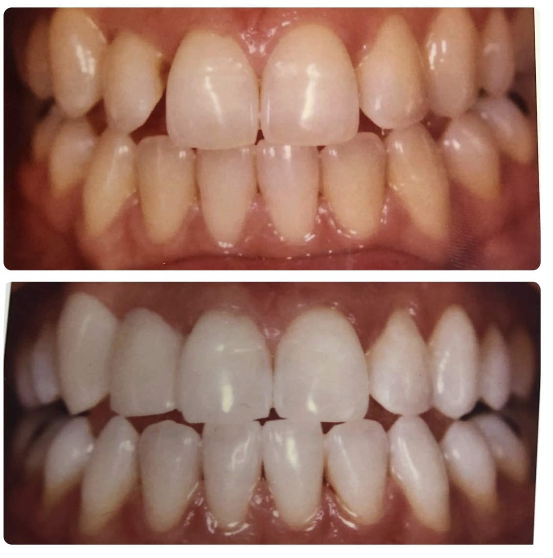 Before and after photos of a professional teeth whitening treatment at Zusin Dental