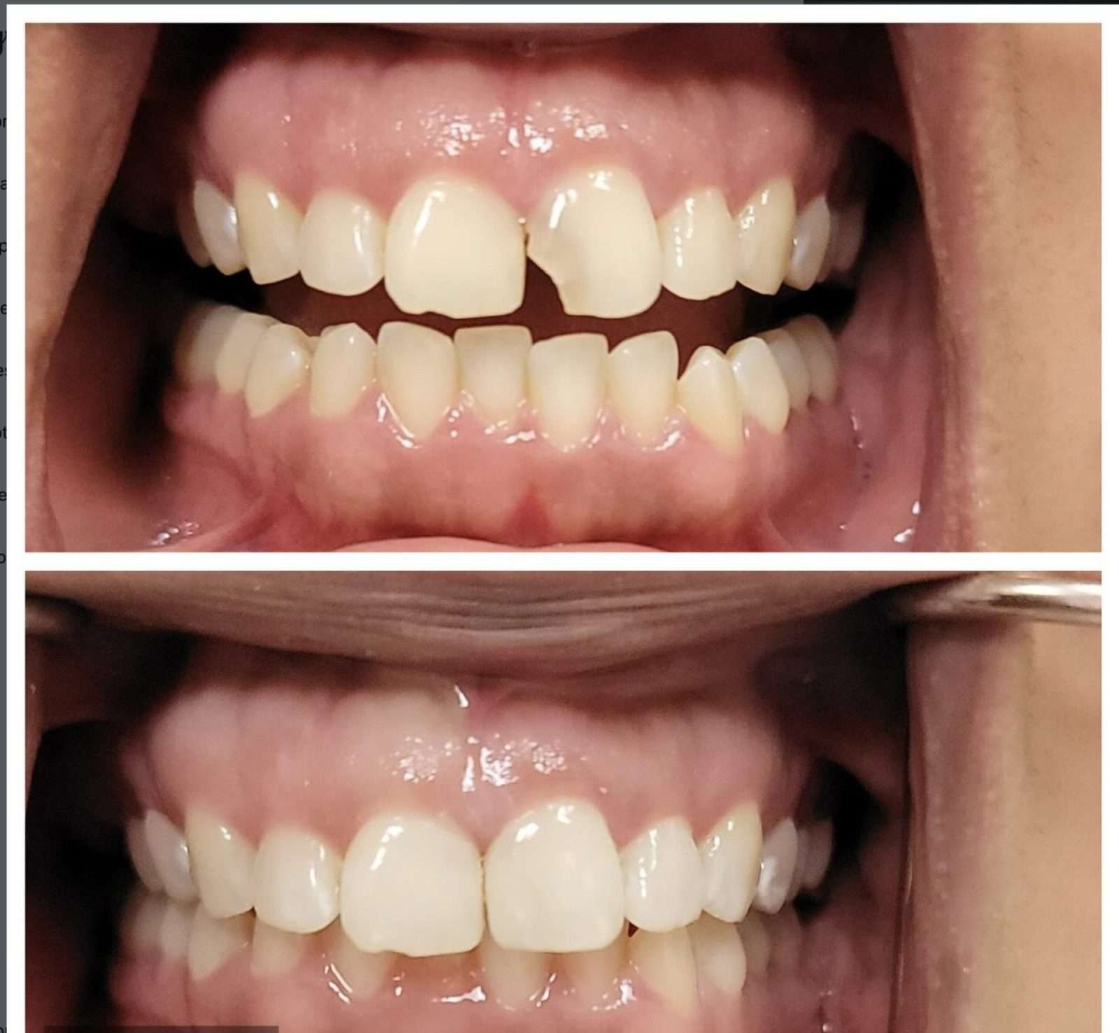 Composite Bonding at Zusin Dental