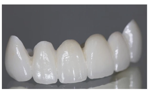 Crown and Bridges at Zusin Dental