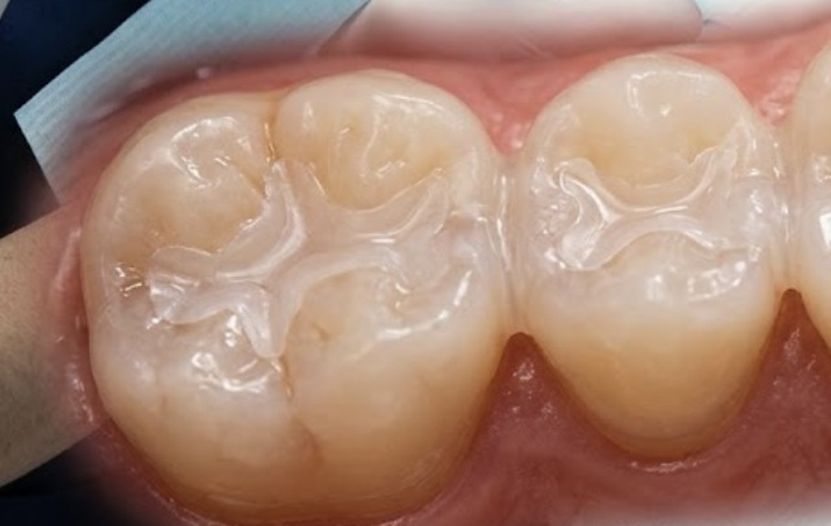 Dental Sealants at Zusin Dental