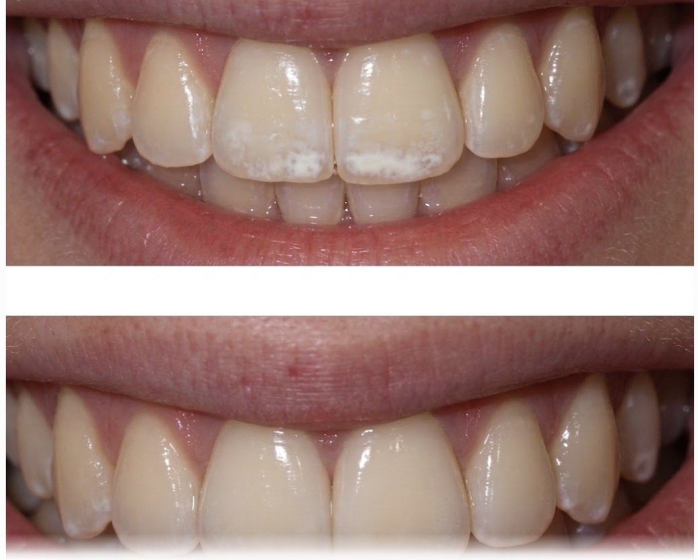 Icon® White Spot Treatment at Zusin Dental