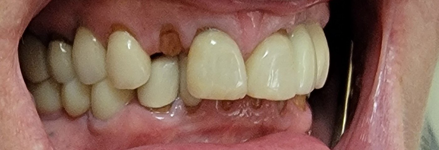 Severe, longstanding overbite with resulting tooth wear and tooth loss