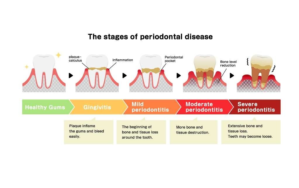 Non-surgical periodontal treatment at Zusin Dental
